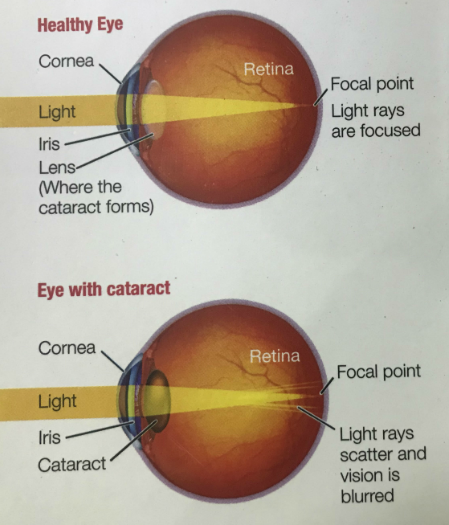 cataract-23